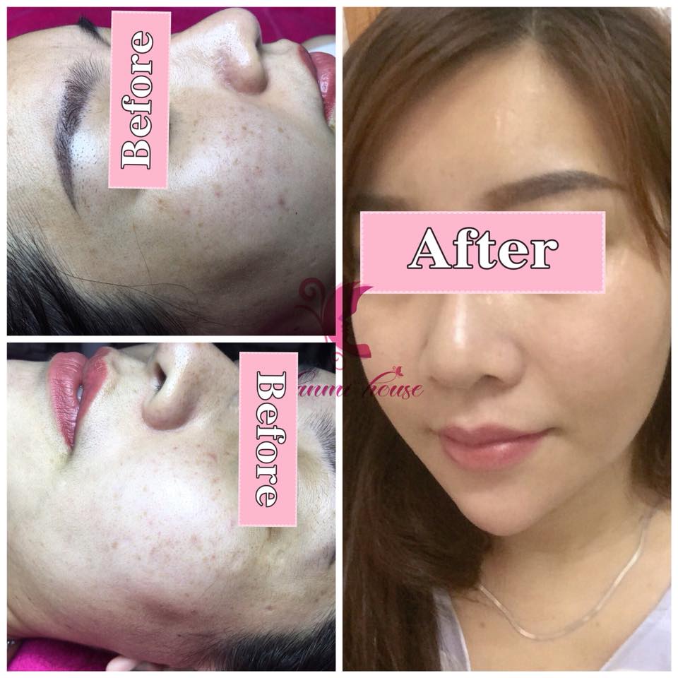 dieu-tri-tan-nhang-tai-hanmi-beauty